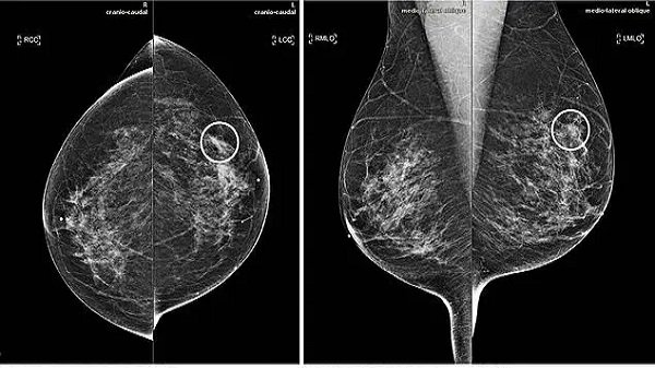 الذكاء الاصطناعي يساعد الأطباء على الكشف المبكر لسرطان الثدي