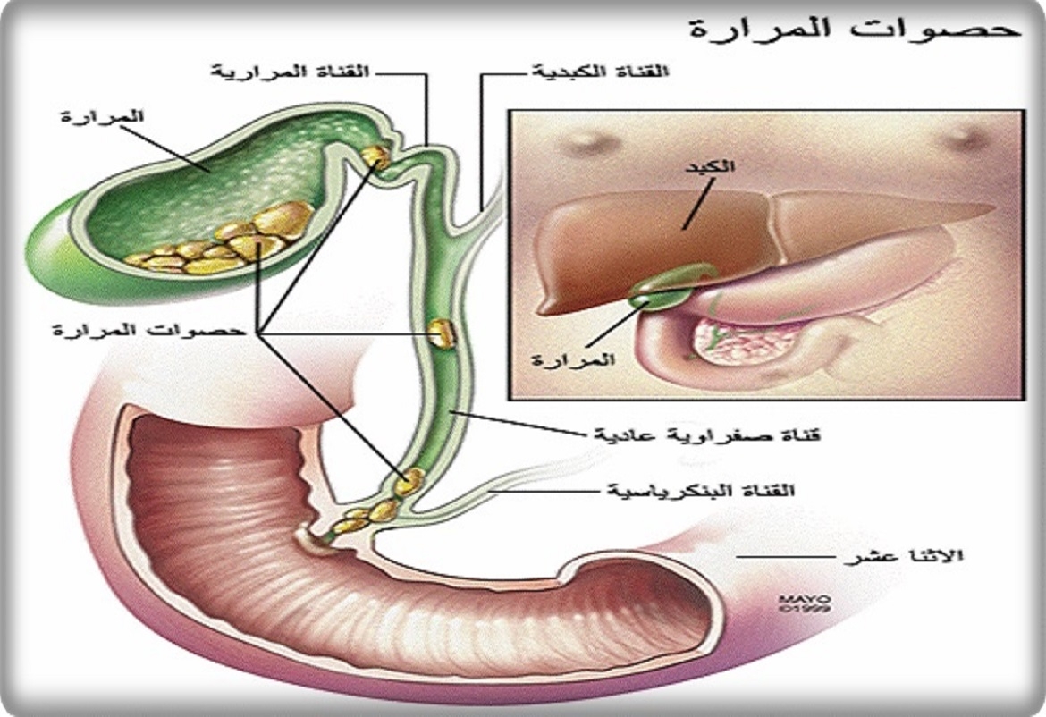 دراسة حديثة: استئصال المرارة ليس ضروريا