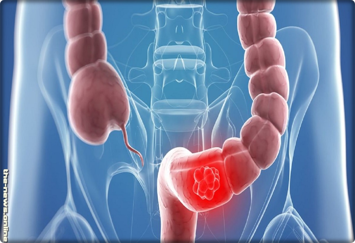 بعض النباتات تقلل خطر الإصابة بسرطان الأمعاء