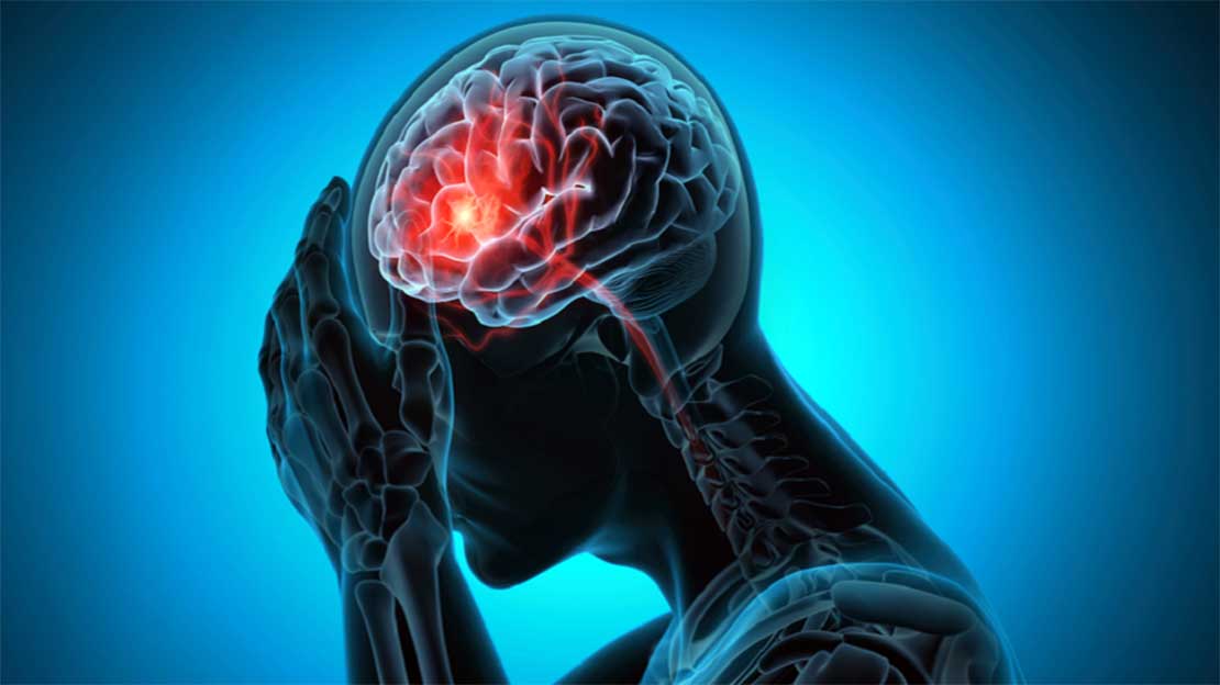 عامل خطر غير متوقع للجلطة الدماغية